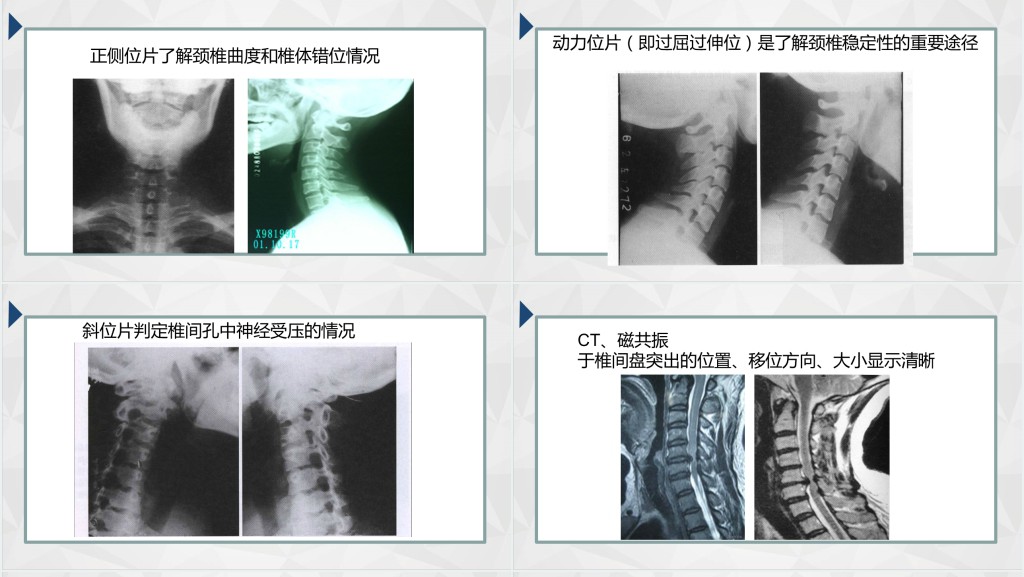 颈椎病发病原因及治疗PPT模板 颈椎病发病原因及治疗PPT模板
