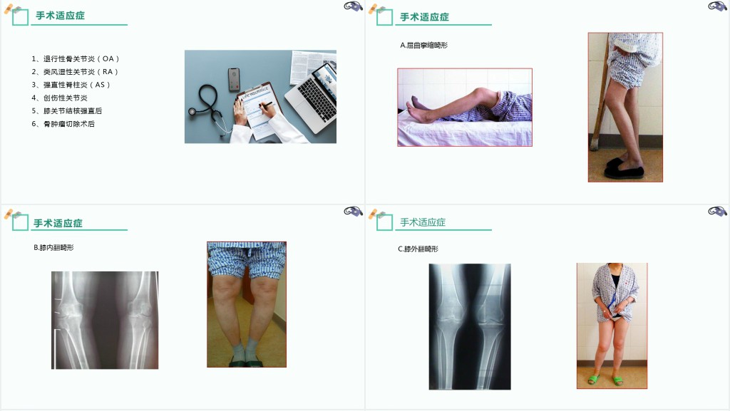 膝关节置换术后护理查房讲解PPT模板 膝关节置换术后护理查房讲解PPT模板