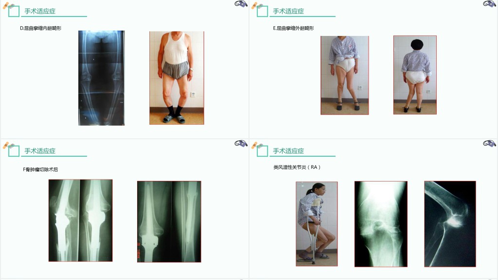 膝关节置换术后护理查房讲解PPT模板 膝关节置换术后护理查房讲解PPT模板