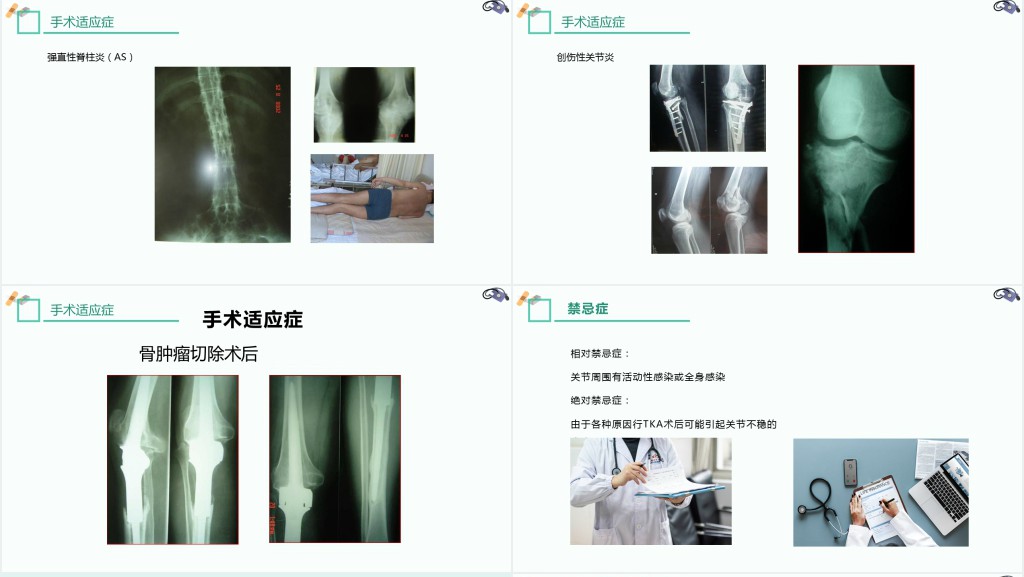 膝关节置换术后护理查房讲解PPT模板 膝关节置换术后护理查房讲解PPT模板