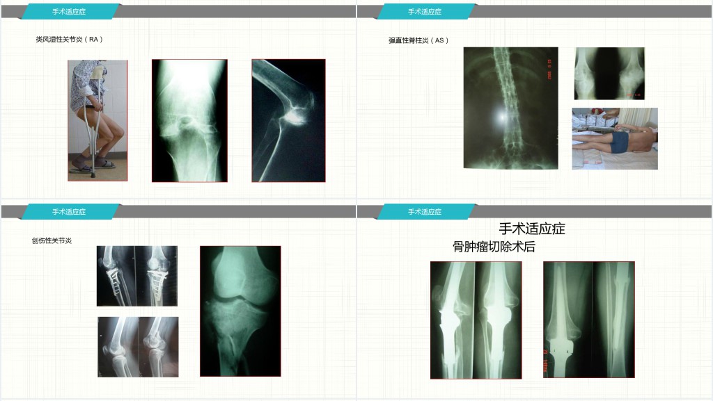 膝关节置换术后护理查房范文PPT模板 膝关节置换术后护理查房范文PPT模板