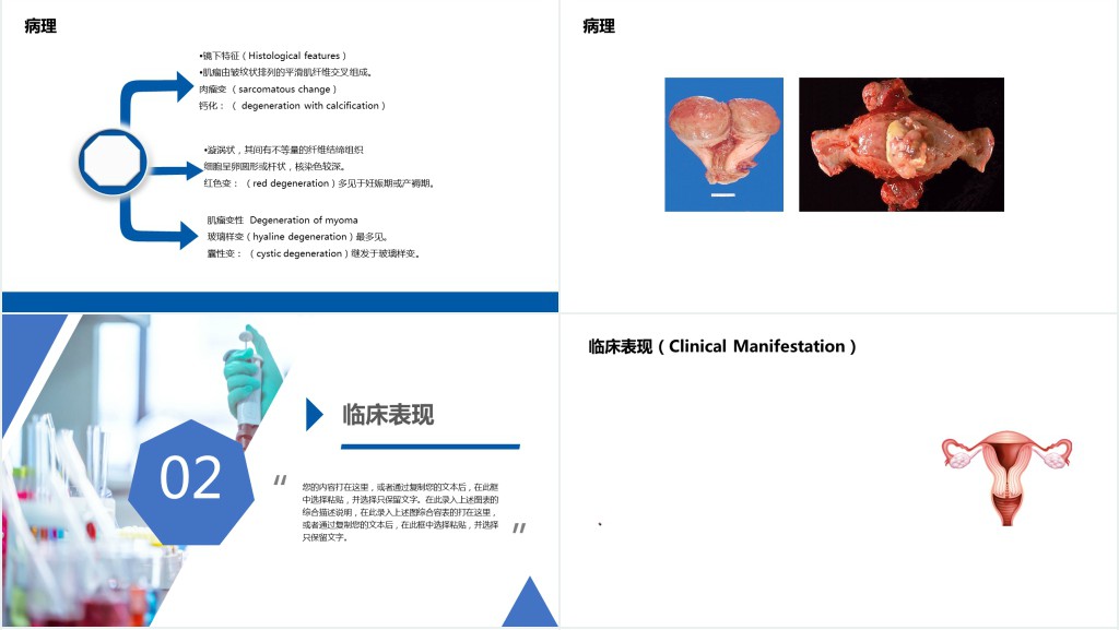 子宫肌瘤PPT医疗教学疾病医理类PPT模板